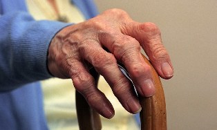 Artritis y artrosis de dedos en una persona mayor. 