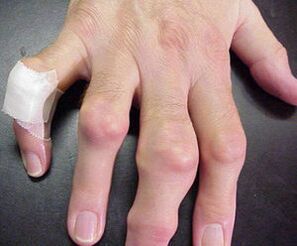 los dedos con deformidades articulares causan dolor