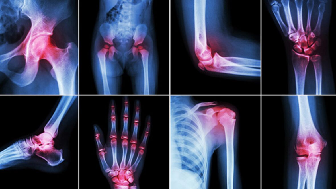 Radiografías para el dolor articular