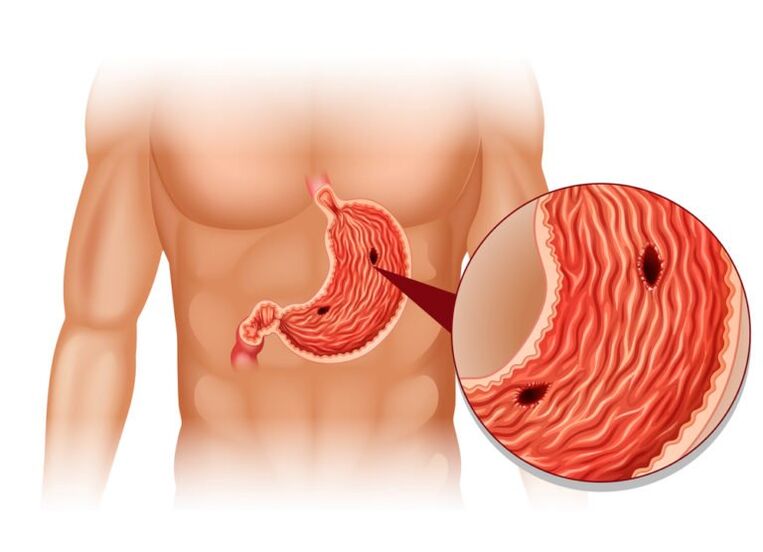 úlcera como causa de dolor debajo de la escápula izquierda detrás