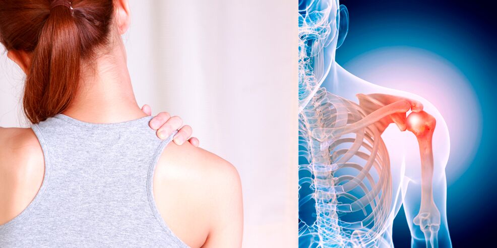 El desarrollo de la osteoartritis del hombro conduce gradualmente a un dolor constante. 