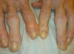 La osteoartritis de las pequeñas articulaciones de las manos