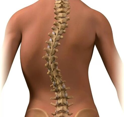 Escoliosis