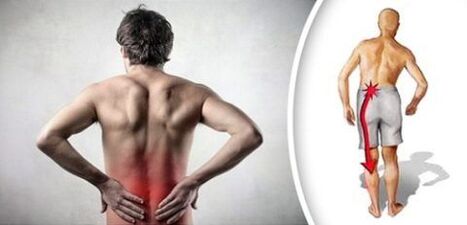 Síndrome de dolor con osteocondrosis lumbar se irradia en las piernas