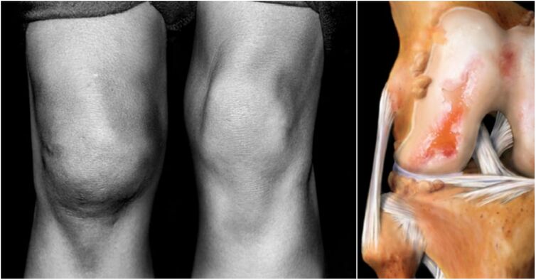 Artrosis de la articulación de la rodilla y dolor en la articulación