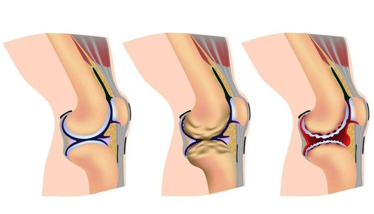 Etapas de deformación en la articulación de la rodilla para la artrosis