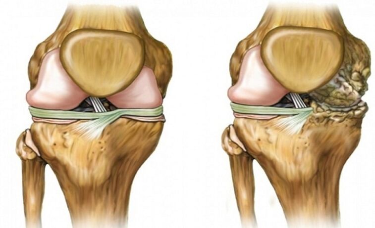 Saludable y afectado por artrosis articular