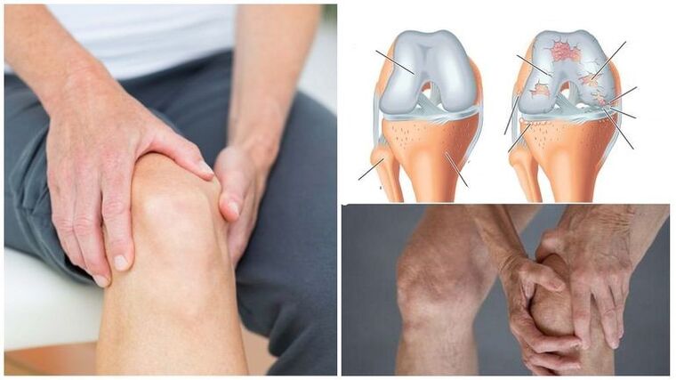 Síntoma de dolor de rodilla de artrosis de la articulación de la rodilla