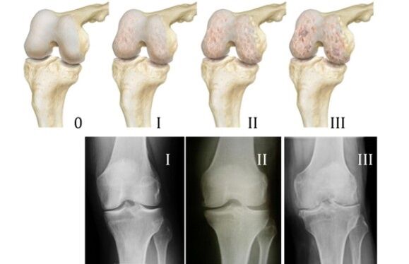 métodos para diagnosticar la artrosis de rodilla